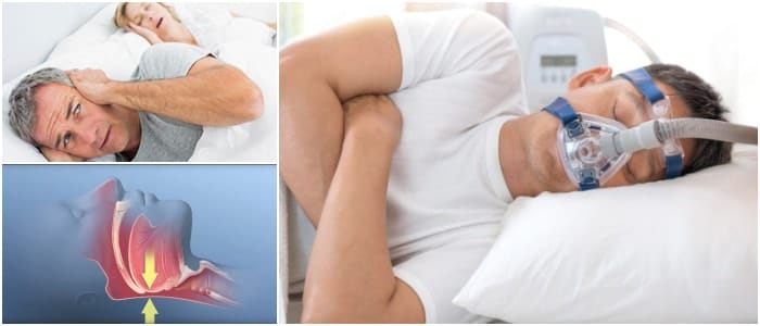 Apnea Obstructiva del Sueño Definición Síntomas Causas Diagnóstico