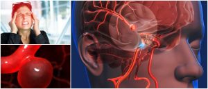 Embolia Cerebral Qué Es Síntomas Causas Diagnóstico y Tratamiento