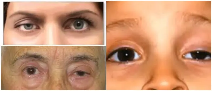 Ptosis Palpebral Tipos S Ntomas Causas Factores De Riesgo