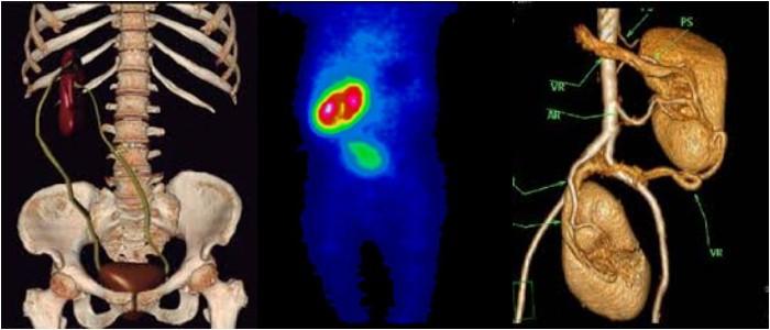 Ectopia Renal Causas S Ntomas Complicaciones Diagn Stico Y