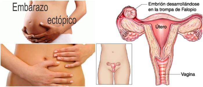 cuales son los sintomas de embarazo ectopico a las 5 semanas
