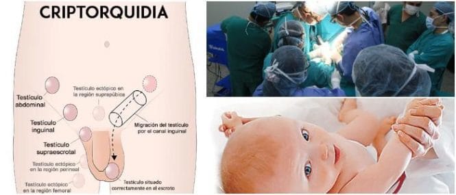 Sintomas de testiculos no descendidos