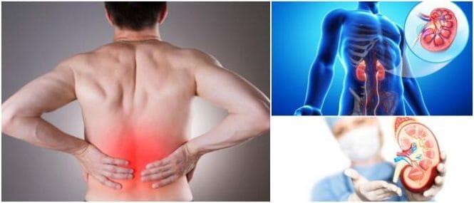 Resultado de imagen de sintomas renales