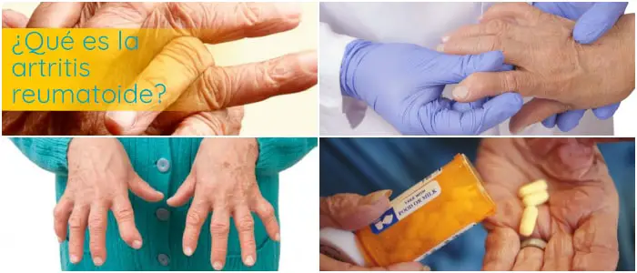 que es una artritis reumatoidea autoinmune