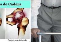 que significa la artrosis de cadera bilateral