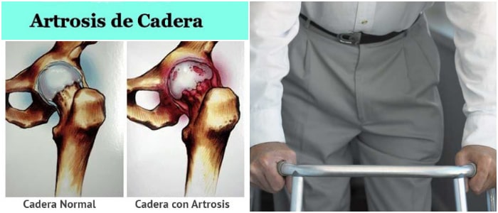 Artrosis De Cadera Causas Síntomas Diagnóstico Tratamiento Y Prevención Arriba Salud 4723