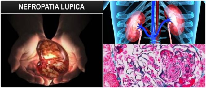 cual es la clasificación de la nefropatía lúpica