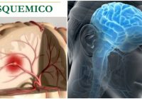 el acv isquemico y la arteria cerebral media