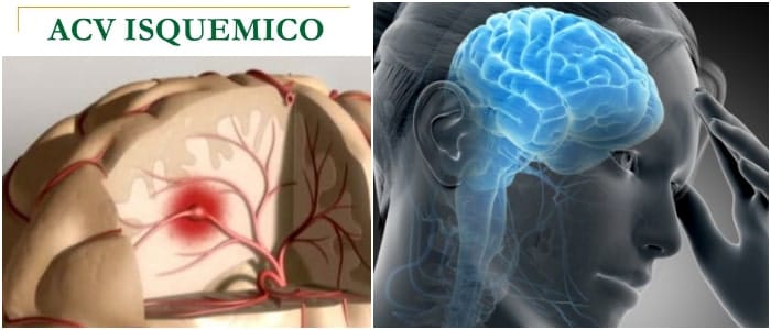 ACV Isquémico: ¿Qué es? Síntomas, Factores de Riesgo, Causas, Tipos ...