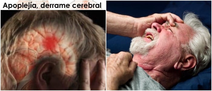 es probable la apoplejía o derrame cerebral infantil