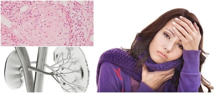 cual es la definición de glomerulonefritis difusa aguda