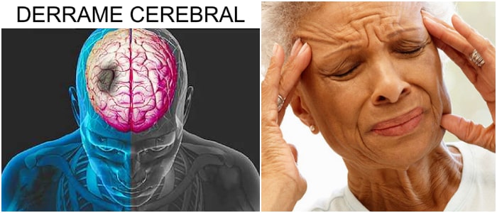 que es un infarto cerebral agudo