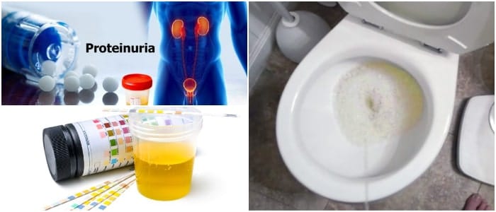 Proteinuria: ¿Qué es? Tipos, Síntomas, Causas, Diagnóstico y