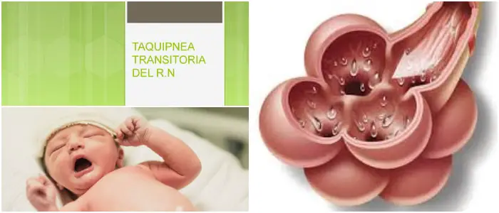 taquipnea transitoria del recién nacido