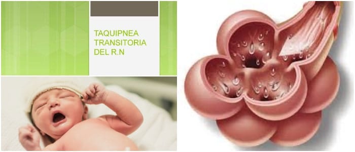 la taquipnea transitoria del recién nacido (ttrn) o mala adaptación pulmonar