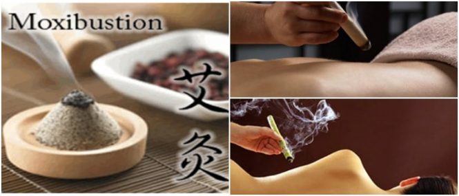 la moxibustion sirve para la fertilidad