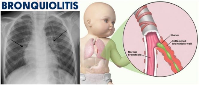 efectos de la bronquiolitis en niños