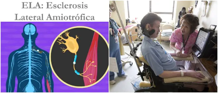 Esclerosis Lateral Amiotrófica Ela ¿qué Es Tipos Causas Síntomas Diagnóstico Tratamiento