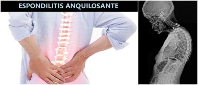 artritis inflamatoria que afecta la columna vertebral