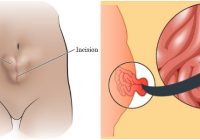 debilitamiento de los músculos abdominales