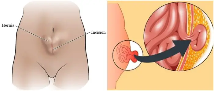 debilitamiento de los músculos abdominales