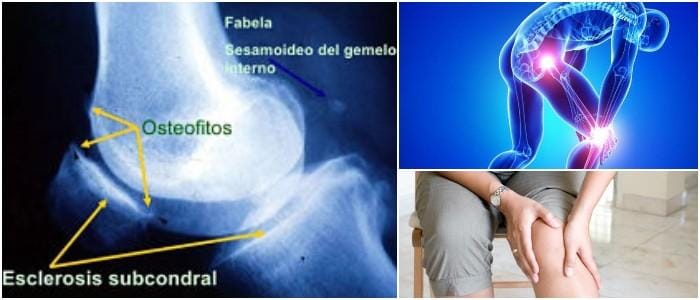 ¿Que es la Esclerosis Ósea Subcondral? Causas, Síntomas, Tratamiento y ...