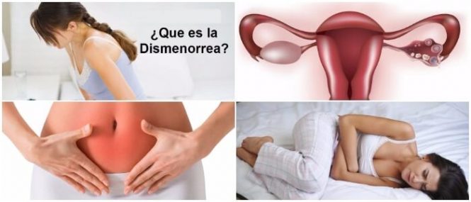 que es la dismenorrea y tratamiento