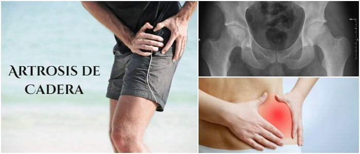 osteoartritis