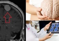 tumor en el cerebro