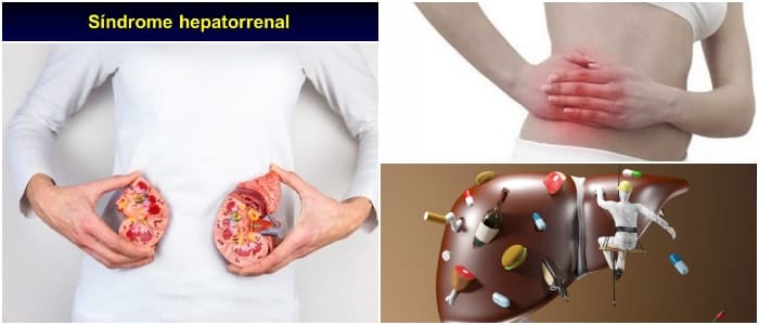 cirrosis