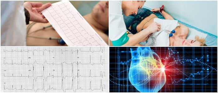 Ritmo Idioventricular Definición, Causas, Características, Manejo y