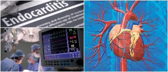 endocardio