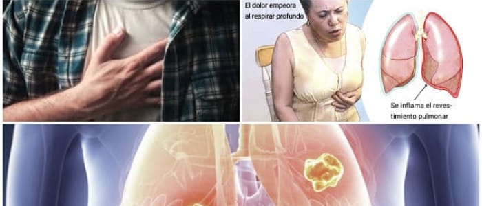 inflamación de la pleura