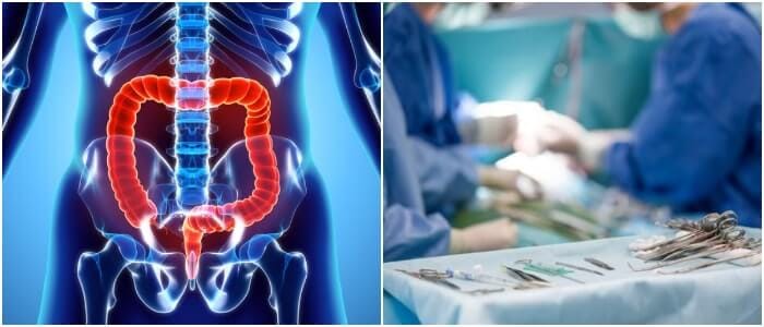 enfermedades inflamatorias del intestino