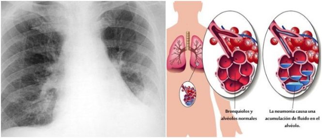 Neumonía Por Aspiración Definición Epidemiología Patógenos Causas Síntomas Diagnóstico Y 