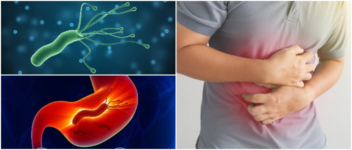 Helicobacter Pylori Qué es Causas de Infección Síntomas Diagnóstico Complicaciones y