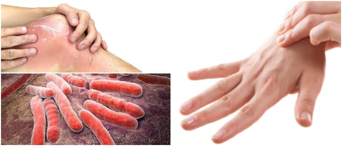 Streptococcus Pyogenes