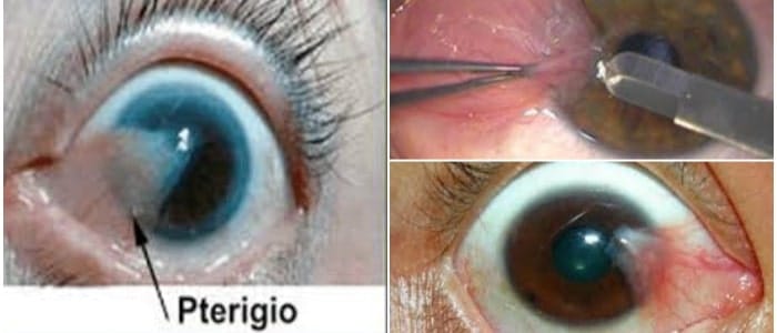 pinguecula