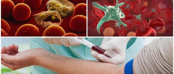 sepsis