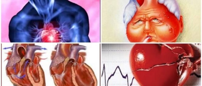 cardiopatia reumática