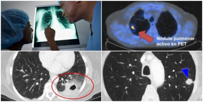 Causas principales de los nódulo pulmonares