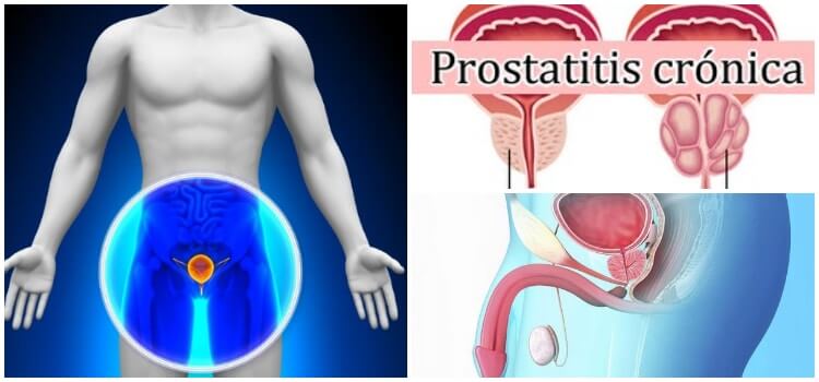que es prostatitis crónica)