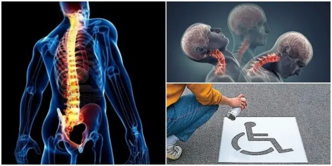 trauma raquimedular