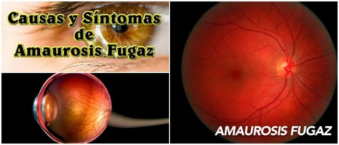 amaurosis fugaz causas