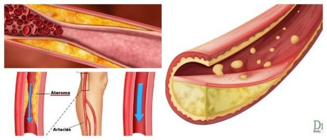 ateroma bulbo carotideo