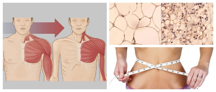 cachexia y cancer