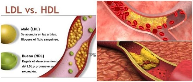 complicaciones de la dislipidemia