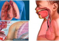 clasificación y concepto de distress respiratorio