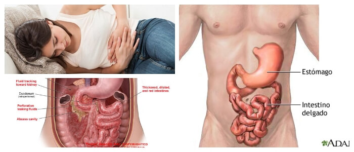 duodenitis aguda