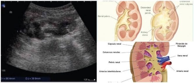 Clasificacion de la ectasia renal